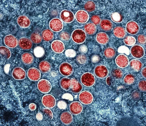 This image provided by the National Institute of Allergy and Infectious Diseases (NIAID) shows a colorized transmission electron micrograph of monkeypox particles (red) found within an infected cell (blue), cultured in the laboratory that was captured and color-enhanced at the NIAID Integrated Research Facility (IRF) in Fort Detrick, Md. On Friday, Aug. 12, 2022, The Associated Press reported on stories circulating online incorrectly claiming that monkeypox hasn't been detected in Georgia drinki